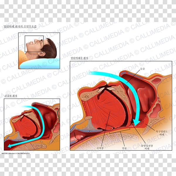 Acromegaly Face Nose Lip Arm, Sleep disorder transparent background PNG clipart