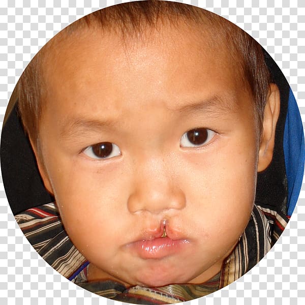 Cleft lip and cleft palate Craniofacial surgery, others transparent background PNG clipart