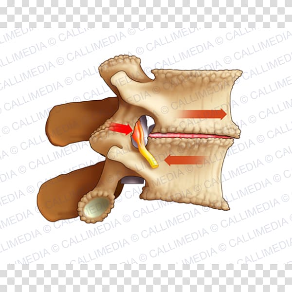 Osteoarthritis Lumbar vertebrae Pain Arthrodesis Sciatica, health transparent background PNG clipart