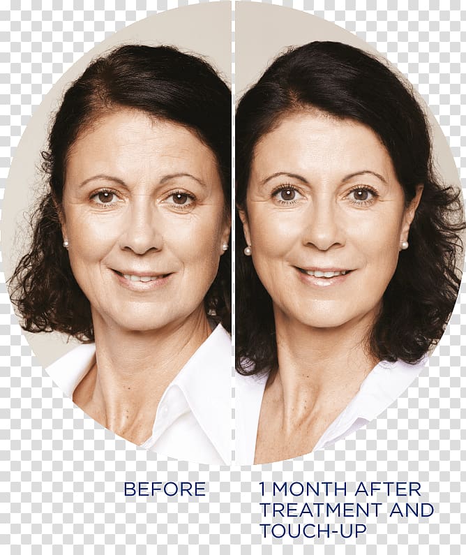 Restylane Injectable filler Nasolabial fold Botulinum toxin, BEFORE AFTER transparent background PNG clipart