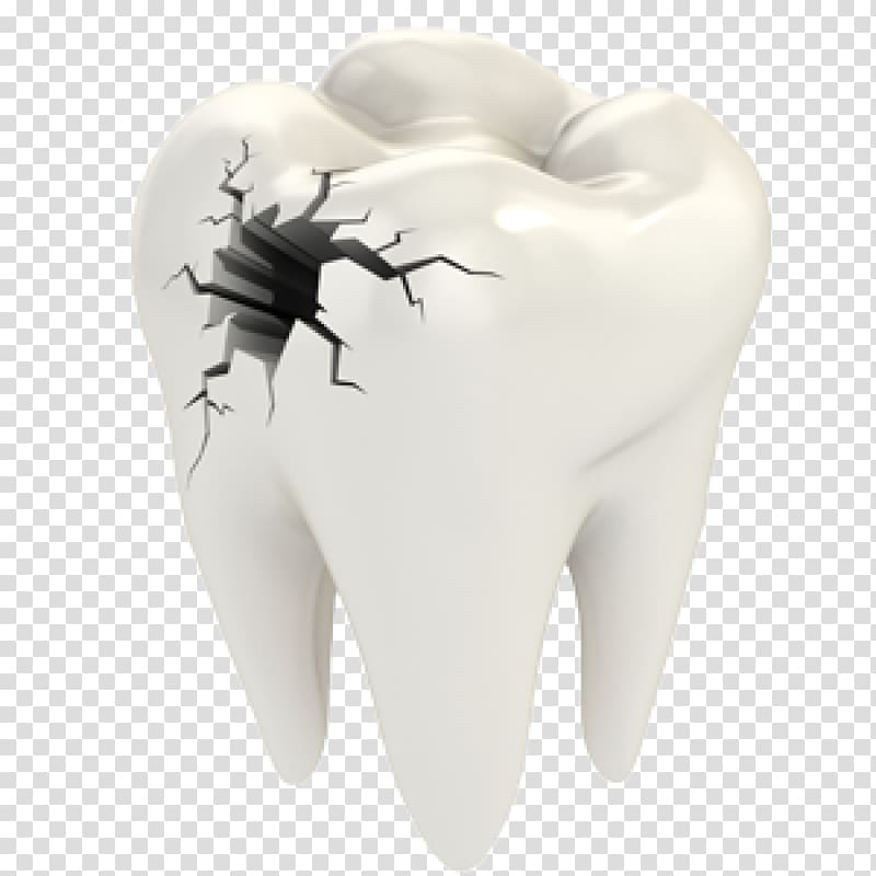 Cracked tooth syndrome Dentistry Dental restoration Human tooth, teeth transparent background PNG clipart