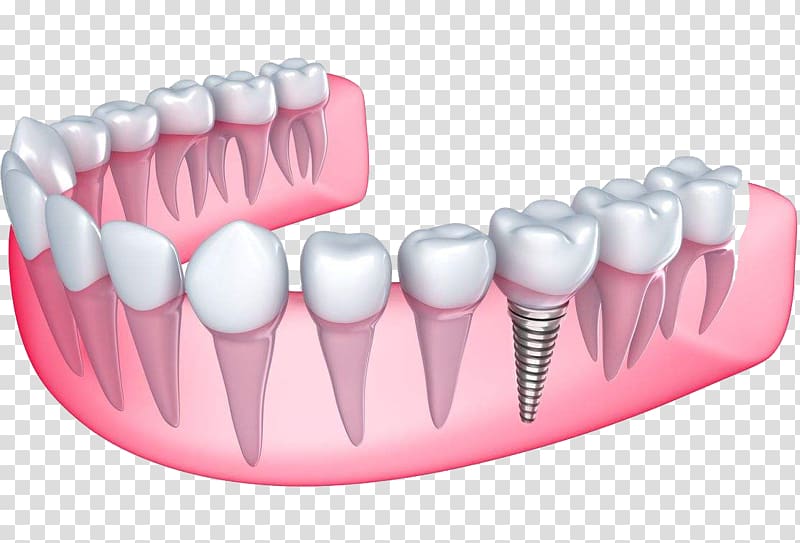 Desert View Dental Dental implant Dentistry Dentures, Dental implant transparent background PNG clipart