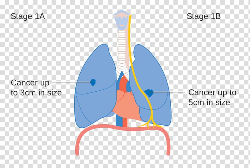 Lung cancer staging, lung transparent background PNG clipart