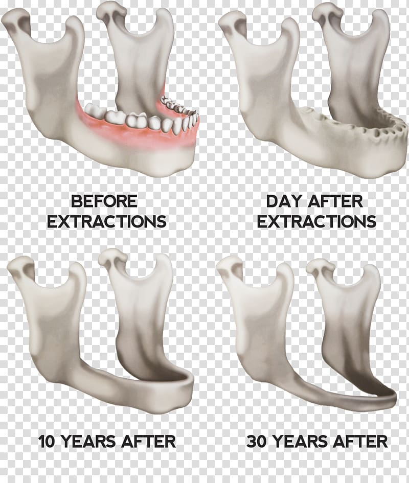 Dentures Jaw Dental implant Tooth, others transparent background PNG clipart