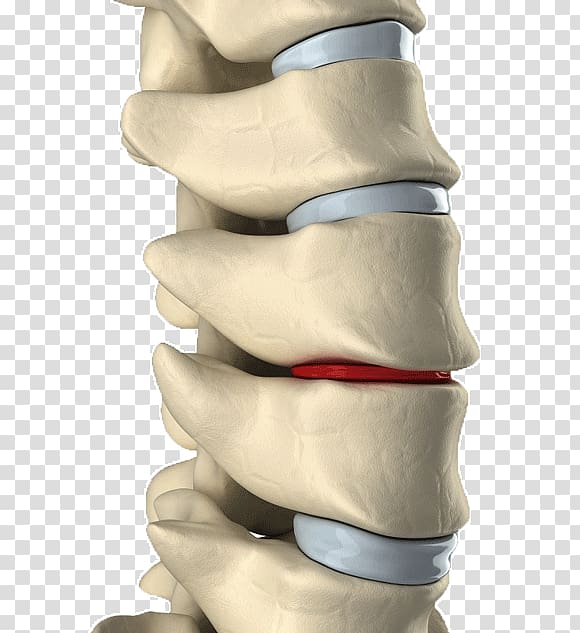 Lumbar disc herniation Intervertebral disc Spinal decompression Back pain Vertebral column, Disease Prevention transparent background PNG clipart