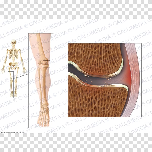 La Gonarthrose Knee osteoarthritis Shoulder, others transparent background PNG clipart