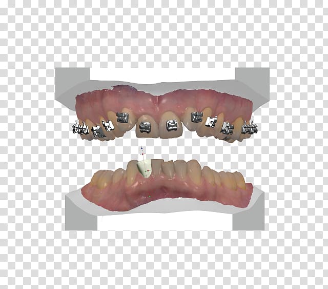 Tooth Dentures Prosthesis Computer-aided design Computer Software, design transparent background PNG clipart