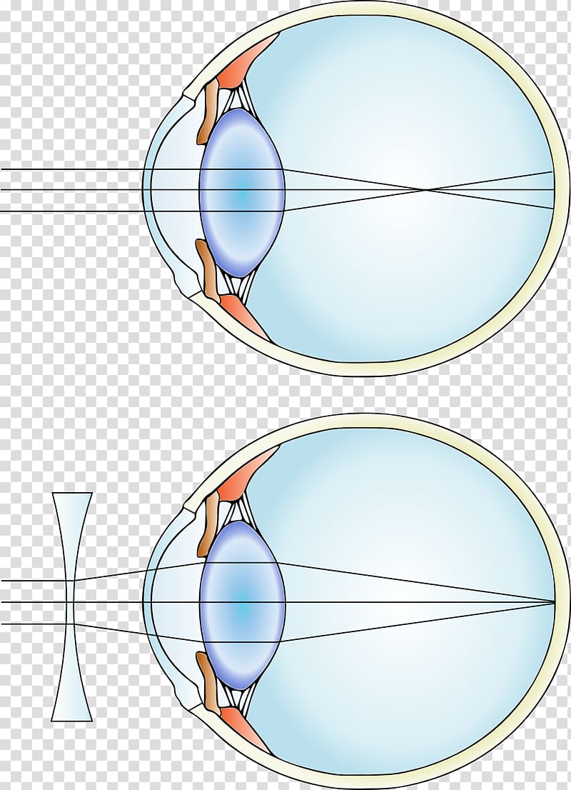 Near-sightedness Hypermetropia Corrective lens Eye, dye transparent background PNG clipart