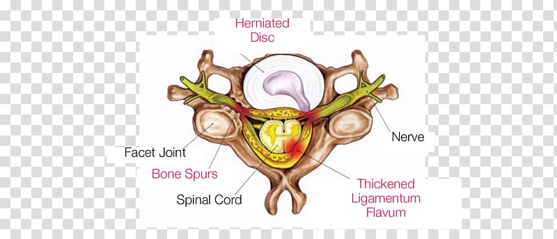 Neck pain Radiculopathy Nerve compression syndrome Vertebral column Cervical vertebrae, others transparent background PNG clipart