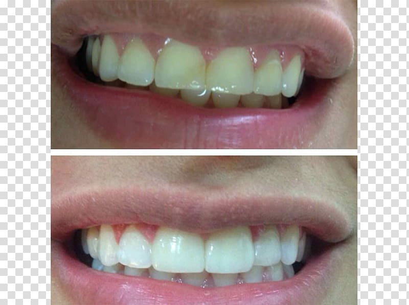 Tooth Veneer Dental implant Dentist Crown, crown transparent background PNG clipart