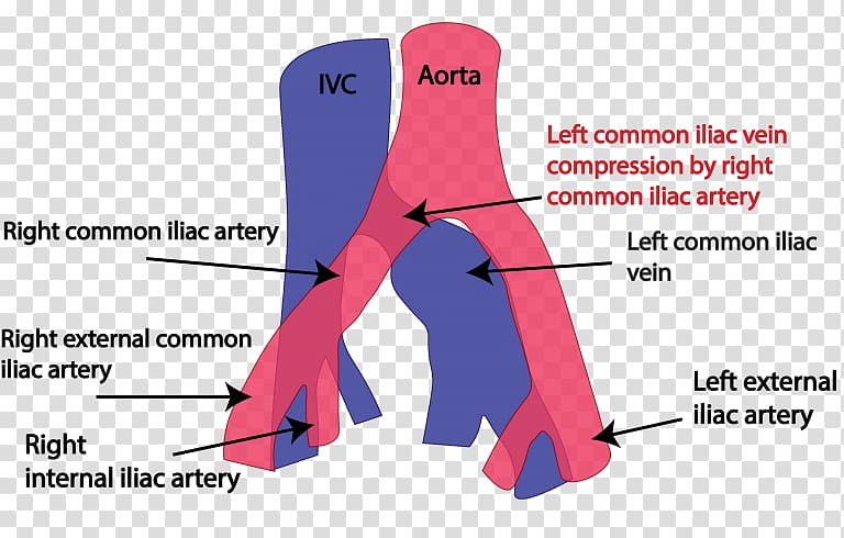 Common iliac vein May–Thurner syndrome Common iliac artery Iliofemoral ligament, others transparent background PNG clipart