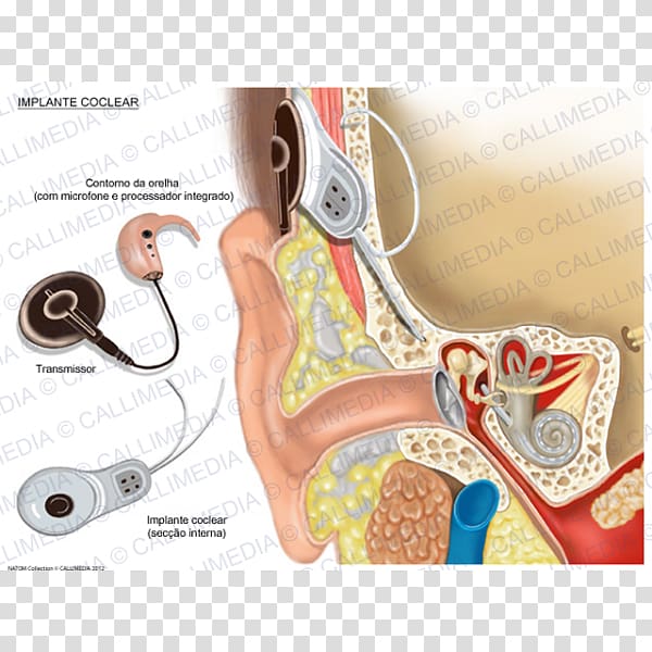 Cochlear implant Hearing, ear transparent background PNG clipart