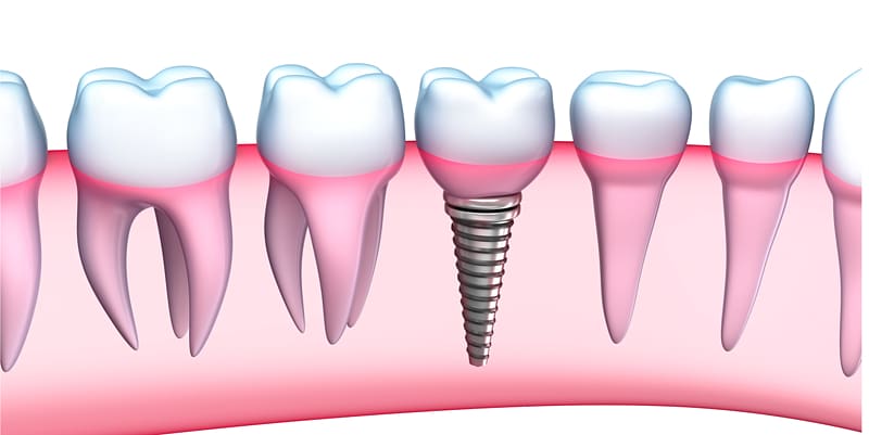 Dental implant Dentistry Human tooth Dentures, teeth transparent background PNG clipart