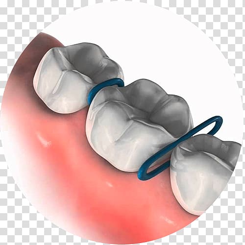 Orthodontics Dental braces Orthodontic spacer Orthodontic technology Rubber Bands, Dental Braces transparent background PNG clipart