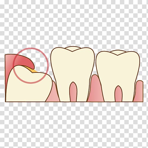 Wisdom tooth Dentist 歯科 Dental extraction, shiraz transparent background PNG clipart