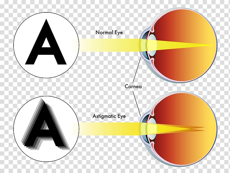 LASIK Astigmatism Refractive surgery Eye surgery, myopia transparent background PNG clipart