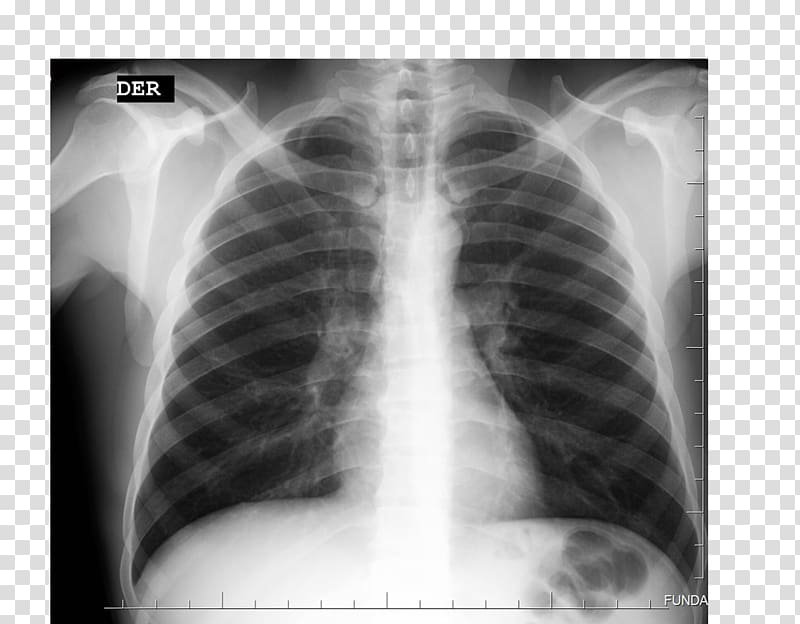 chest x ray clipart