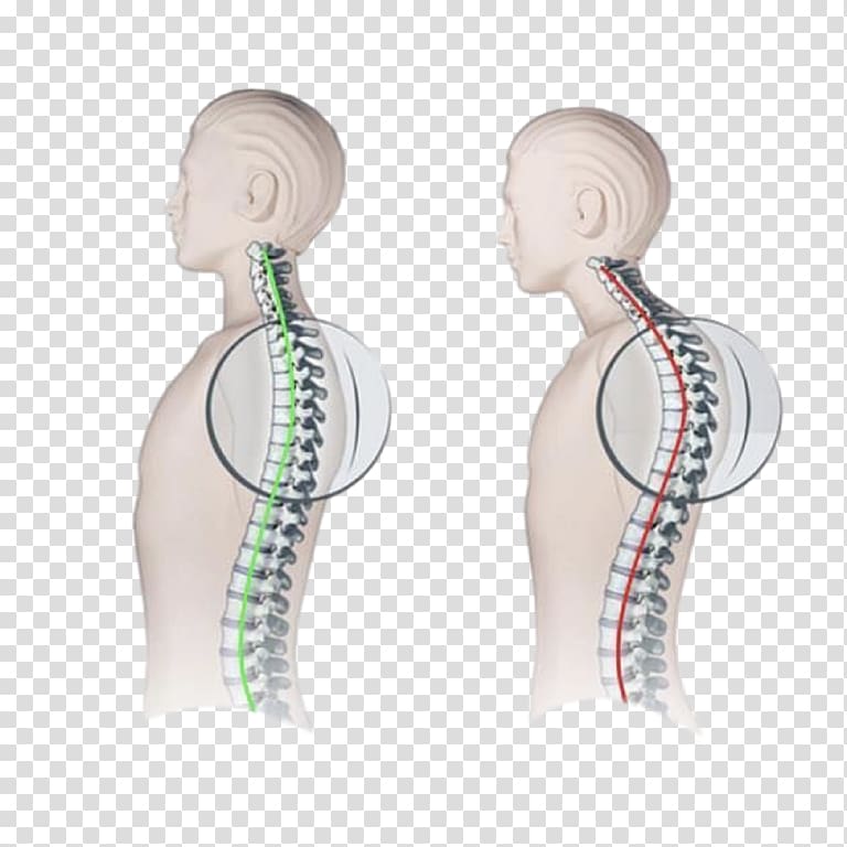 Kyphosis Vertebral column Scoliosis Lordosis Scheuermann\'s disease, others transparent background PNG clipart