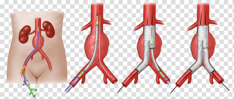 Abdominal aortic aneurysm Endovascular aneurysm repair Vascular surgery, heart transparent background PNG clipart