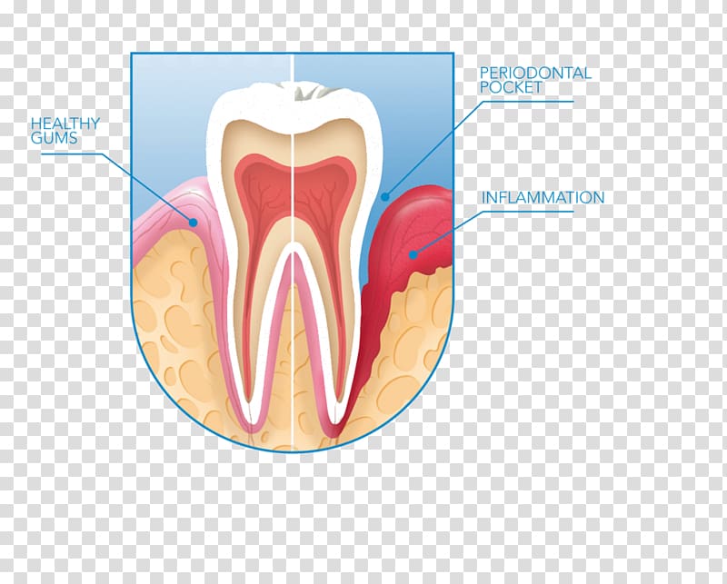 Bleeding on probing Periodontal disease Gums Dentistry, oral health transparent background PNG clipart