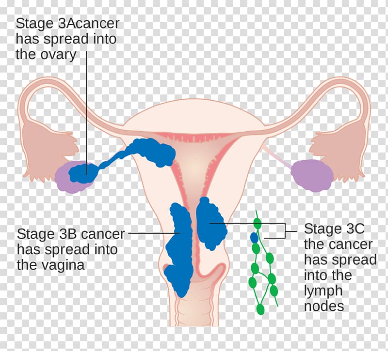 Uterine cancer Endometrial cancer Endometrium Cancer staging, Nettle transparent background PNG clipart