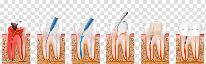 Dentistry Endodontic therapy Endodontics, orange transparent background PNG clipart