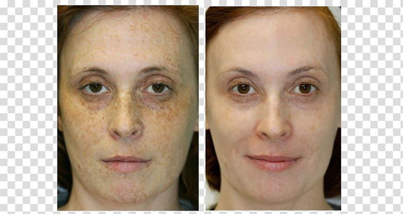 Liver spot Eyebrow Face Skin rejuvenation, Face transparent background PNG clipart