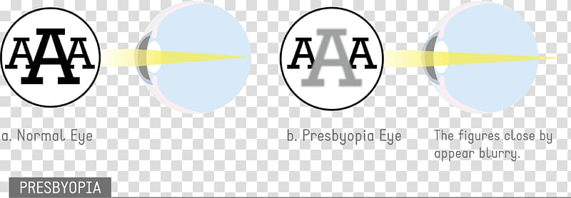Astigmatism Eye disease Visual perception Amblyopia, Eye transparent background PNG clipart