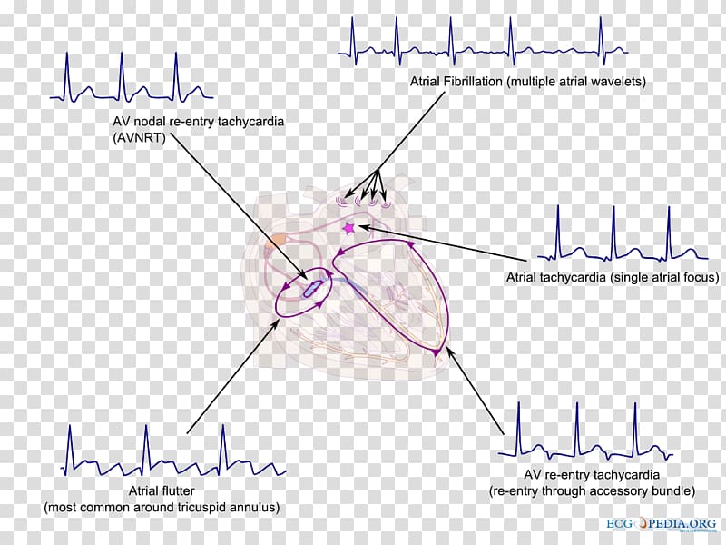 Supraventricular tachycardia Heart arrhythmia Atrial fibrillation, heart transparent background PNG clipart