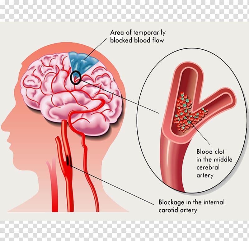 Transient ischemic attack Ischemic Stroke Ischemia Symptom, Brain transparent background PNG clipart