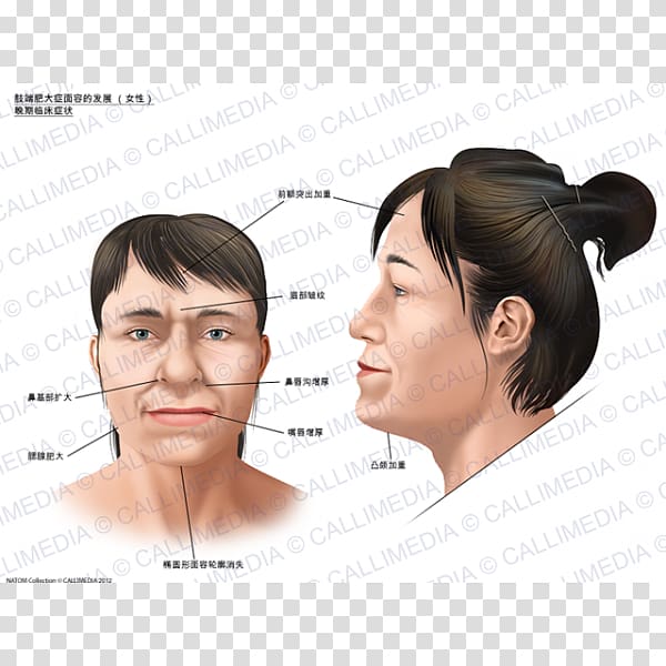 Acromegaly Face Symptom Skull bossing Gigantism, Face transparent background PNG clipart