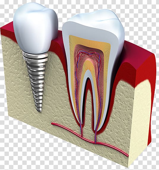 Dental implant Dentistry Tooth Surgery, others transparent background PNG clipart