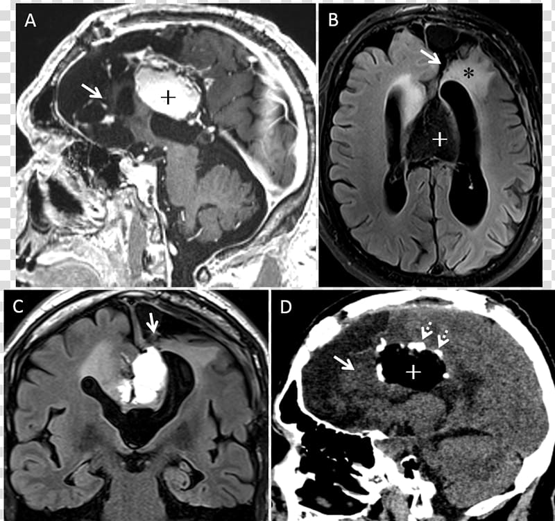 Computed tomography Brain Fluid-attenuated inversion recovery Cortical dysplasia, Brain transparent background PNG clipart