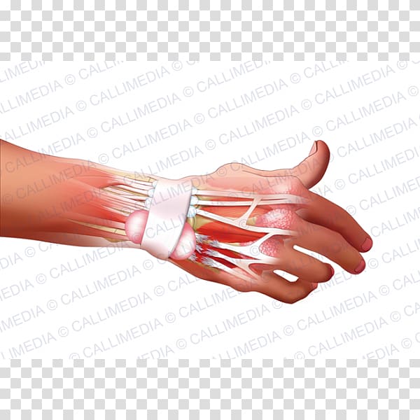 Hand model Nail Rheumatoid arthritis Disease, hand transparent background PNG clipart