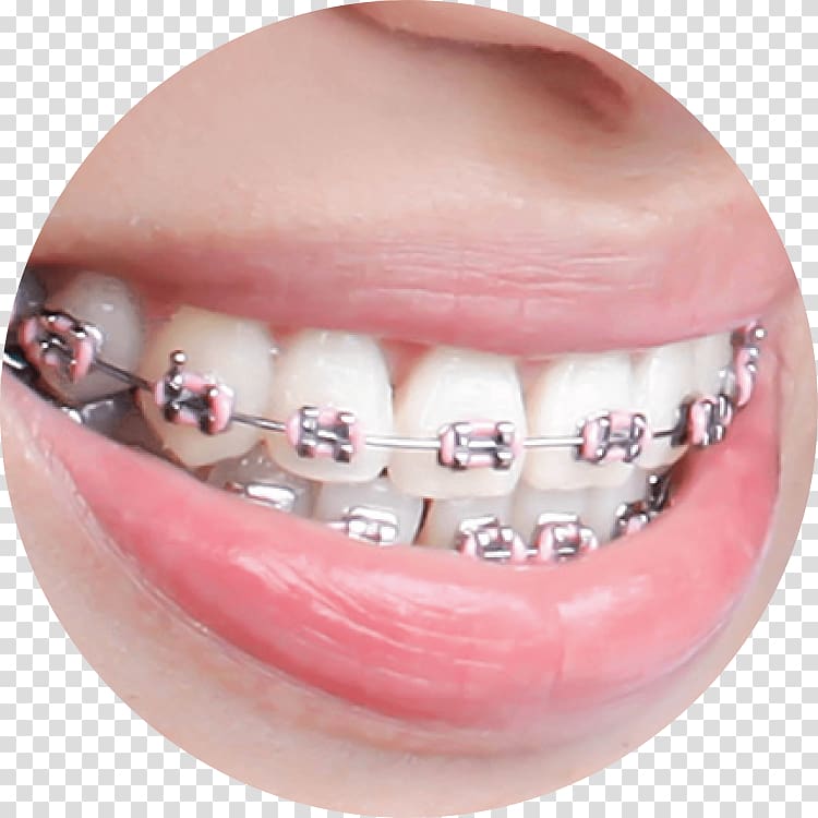 Dental braces Dentistry Orthodontics Human tooth, orthodontics surgery transparent background PNG clipart