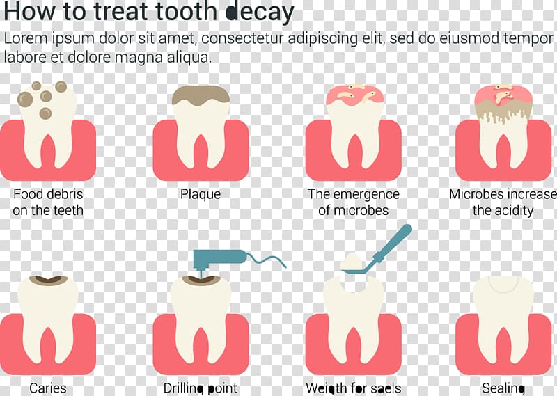 Tooth decay Dentistry Euclidean , How to treat dental caries infographic material transparent background PNG clipart