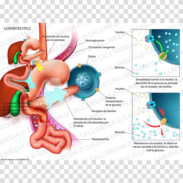 Diabetes mellitus type 2 Illustration Internal medicine Niimi Clinic, diabetes cartoon transparent background PNG clipart