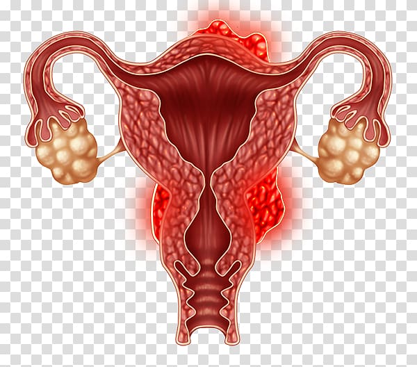 Ovary Uterine fibroid Laparoscopy Uterus Gynaecology, health transparent background PNG clipart