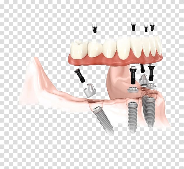 Dental implant Abutment Dentistry Dentures, crown transparent background PNG clipart