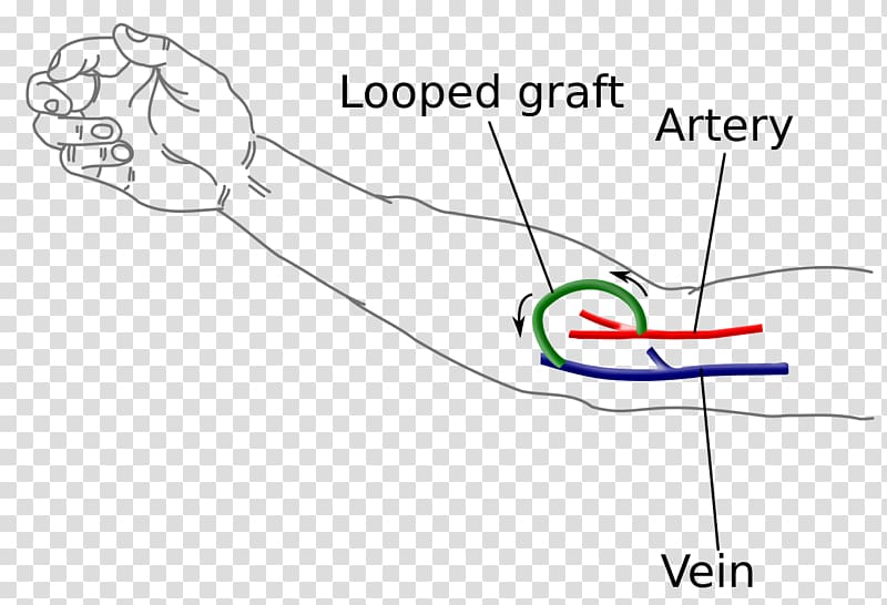 Arteriovenous fistula Hemodialysis Vascular access Vascular surgery, blood transparent background PNG clipart