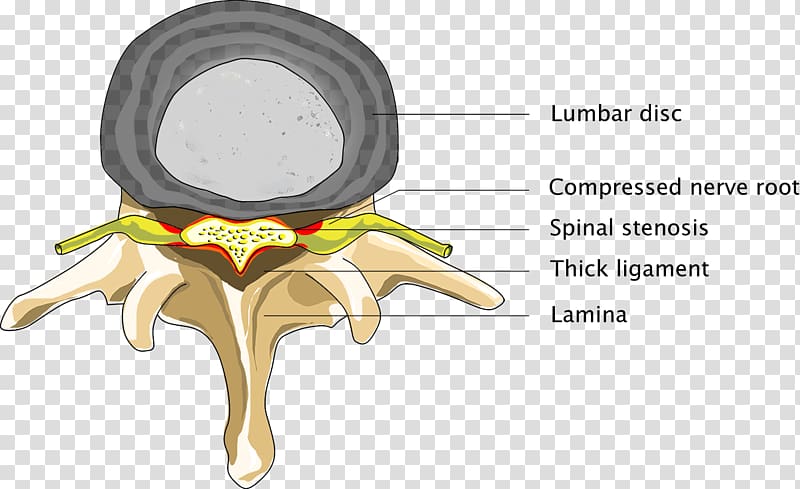 Spinal disc herniation Spinal cord Spinal stenosis Back pain, spinal back transparent background PNG clipart