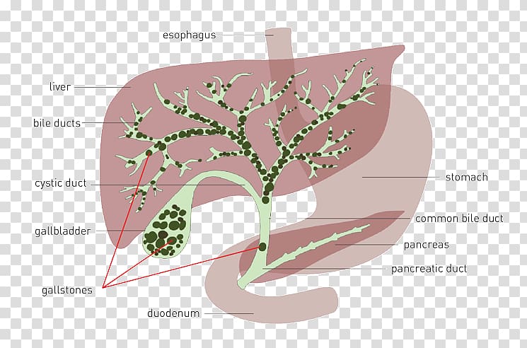 Liver and Gallbladder Gallstone Bile Gallbladder flush, activities will be reduced at full time transparent background PNG clipart