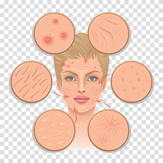 Skin infection Human skin, Acne Scars transparent background PNG clipart