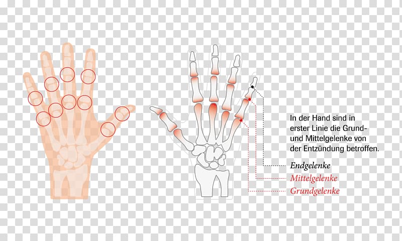 Joint Hand Rheumatoid arthritis Rheumatism, arthritis transparent background PNG clipart