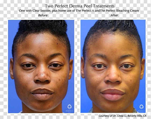 Chemical peel Dermis Skin The Perfect Derma Peel Face, Skin care model transparent background PNG clipart