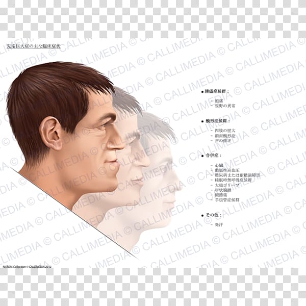 Acromegaly Symptom Gigantism Therapy Medical sign, acromegalia transparent background PNG clipart