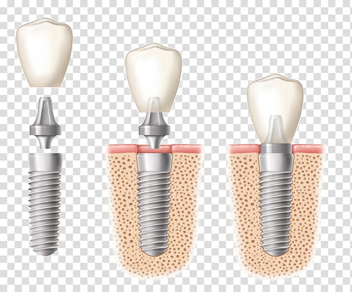 Dental implant Dentistry Tooth, others transparent background PNG clipart