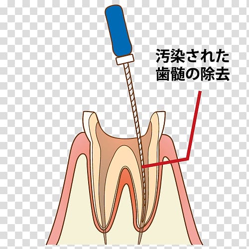 Tooth Dentist 歯科 Endodontic therapy Root canal, Captions transparent background PNG clipart