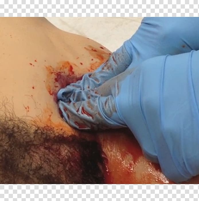 Gunshot wound Patient Injury Amputation, Wound transparent background PNG clipart