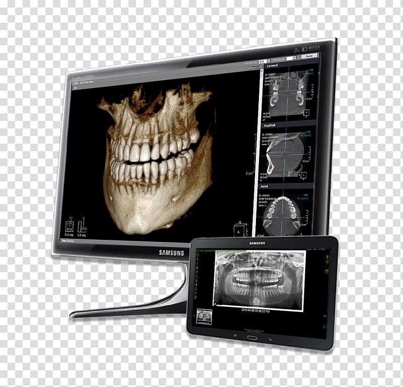 Dentistry Computer Software VELscope Visualization Medical diagnosis, effect chart of dental restoration transparent background PNG clipart